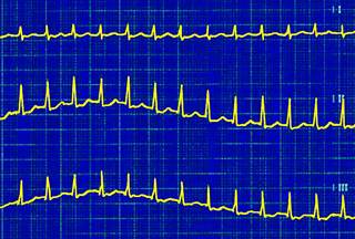 A patient has experienced heart palpitations for the past week, which became worse after mowing his lawn in the hot summer sun. <i>Photo Credit: ISM / Sovereign</i> A patient has experienced heart palpitations for the past week, which became worse after mowing his lawn in the hot summer sun. <i>Photo Credit: ISM / Sovereign</i>