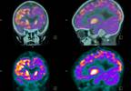 Cardiovascular Disease Risk in PLWHIV Alters Brain Glucose Metabolism Cardiovascular Disease Risk in PLWHIV Alters Brain Glucose Metabolism