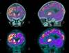 Cardiovascular Disease Risk in PLWHIV Alters Brain Glucose Metabolism Cardiovascular Disease Risk in PLWHIV Alters Brain Glucose Metabolism