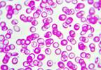 Anemia Identified as Risk Factor for Contrast-Induced Acute Kidney Injury Anemia Identified as Risk Factor for Contrast-Induced Acute Kidney Injury