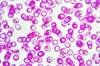 Clinical Review: Treating Iron Defiency Anemia in Heart Failure Clinical Review: Treating Iron Defiency Anemia in Heart Failure