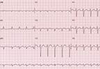 Short-Run Atrial Tachyarrhythmia Associated With Increased Stroke Risk Short-Run Atrial Tachyarrhythmia Associated With Increased Stroke Risk