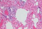 Pediatric Pulmonary Embolism: 9 Predictors Identified Pediatric Pulmonary Embolism: 9 Predictors Identified