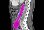 Ruptured Abdominal Aortic Aneurysms: Open vs Endovascular Repair Ruptured Abdominal Aortic Aneurysms: Open vs Endovascular Repair