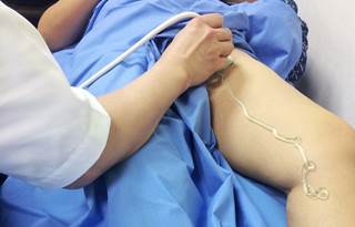 Trained general practitioners and vascular experts had excellent agreement when using compression ultrasonography. Trained general practitioners and vascular experts had excellent agreement when using compression ultrasonography.