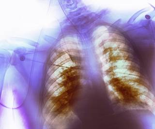 In the emergency department, the patient was found to be lethargic and her oxygen saturations were in the low 70s. In the emergency department, the patient was found to be lethargic and her oxygen saturations were in the low 70s.