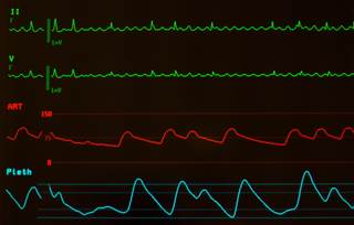 Atrial flutter may be associated with a lower risk for stroke compared with atrial fibrillation. Atrial flutter may be associated with a lower risk for stroke compared with atrial fibrillation.