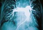 Global Pulmonary Vascular Remodeling and Pulmonary Hypertension in Heart Failure Global Pulmonary Vascular Remodeling and Pulmonary Hypertension in Heart Failure