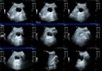 Stroke Risk May Be Determined by Number of Renal Cysts Stroke Risk May Be Determined by Number of Renal Cysts