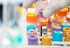 Pulmonary Arterial Hypertension: Biomarker May Predict 5-Year Survival Pulmonary Arterial Hypertension: Biomarker May Predict 5-Year Survival