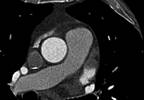 Atrial Fibrillation Treated With LAA Occlusion Reduces Thromboembolism Risk Atrial Fibrillation Treated With LAA Occlusion Reduces Thromboembolism Risk