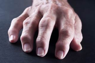 Abatacept may confer a reduction in CV risk in patients with rheumatoid arthritis, particularly if they also have diabetes. Abatacept may confer a reduction in CV risk in patients with rheumatoid arthritis, particularly if they also have diabetes.