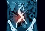 Aortic Disease Risk May Be Attenuated by Type 2 Diabetes Aortic Disease Risk May Be Attenuated by Type 2 Diabetes