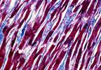 Myocarditis Rare Side Effect of Immune Checkpoint Inhibitors Myocarditis Rare Side Effect of Immune Checkpoint Inhibitors