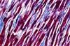 Microbes Implicated in Myocarditis Microbes Implicated in Myocarditis