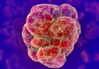 Pulmonary Embolism With Low Mortality Risk Treated in Outpatient Setting Pulmonary Embolism With Low Mortality Risk Treated in Outpatient Setting