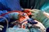 Opioid Use Disorder Linked to Increased Complications After Cardiac Surgery Opioid Use Disorder Linked to Increased Complications After Cardiac Surgery