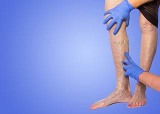 Patients with varicose veins may also have increased risks for pulmonary embolism and peripheral artery disease. Patients with varicose veins may also have increased risks for pulmonary embolism and peripheral artery disease.