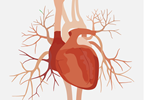 Right Atrium Enlargement Predicts Supraventricular Arrhythmia Risk in PAH Right Atrium Enlargement Predicts Supraventricular Arrhythmia Risk in PAH