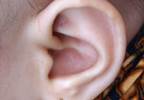 Cardiac Surgery in Infancy May Increase Risk for Hearing Loss Cardiac Surgery in Infancy May Increase Risk for Hearing Loss