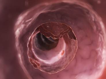 A 64-Year-Old Woman With Colorectal Cancer Presents to ED With Severe Chest Pain A 64-Year-Old Woman With Colorectal Cancer Presents to ED With Severe Chest Pain