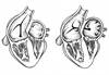 Patent Foramen Ovale Characteristics May Predict Benefits of PFO Closure Patent Foramen Ovale Characteristics May Predict Benefits of PFO Closure