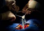 Rapid Deployment Valve for Aortic Stenosis Ups Stroke Risk Rapid Deployment Valve for Aortic Stenosis Ups Stroke Risk