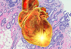 AHA Examines CVD and Breast Cancer Relationship AHA Examines CVD and Breast Cancer Relationship