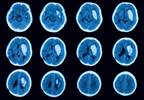 Anxiety May Increase Stroke, Intracranial Hemorrhage in Atrial Fibrillation Anxiety May Increase Stroke, Intracranial Hemorrhage in Atrial Fibrillation