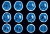 Anxiety May Increase Stroke, Intracranial Hemorrhage in Atrial Fibrillation Anxiety May Increase Stroke, Intracranial Hemorrhage in Atrial Fibrillation