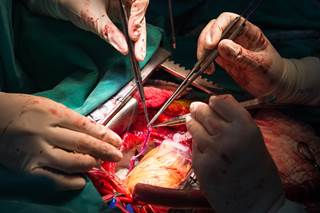 There was a significant difference between the ticagrelor plus aspirin vs aspirin-only groups in terms of saphenous vein graft patency rates at 1-year follow-up. There was a significant difference between the ticagrelor plus aspirin vs aspirin-only groups in terms of saphenous vein graft patency rates at 1-year follow-up.