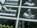 Composite Echo Score Predicts PH in Interstitial Lung Disease Composite Echo Score Predicts PH in Interstitial Lung Disease
