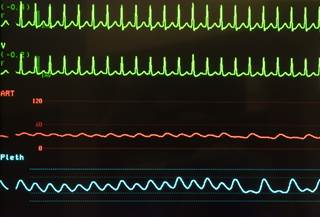 Tachycardia significantly predicts mortality in lung cancer, leukemia, lymphoma, multiple myeloma Tachycardia significantly predicts mortality in lung cancer, leukemia, lymphoma, multiple myeloma
