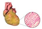 LV Strain, Hypertrophy Predict Heart Failure in Asymptomatic T2D LV Strain, Hypertrophy Predict Heart Failure in Asymptomatic T2D
