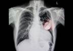 Permanent Pacemaker After TAVR Increases Mortality, Readmission Risks Permanent Pacemaker After TAVR Increases Mortality, Readmission Risks