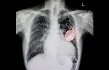 Permanent Pacemaker After TAVR Increases Mortality, Readmission Risks Permanent Pacemaker After TAVR Increases Mortality, Readmission Risks