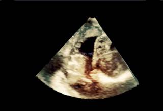 Intracardiac complications and heart failure were common in patients considered high risk and patients with either bicuspid aortic valve or mitral valve prolapse. Intracardiac complications and heart failure were common in patients considered high risk and patients with either bicuspid aortic valve or mitral valve prolapse.