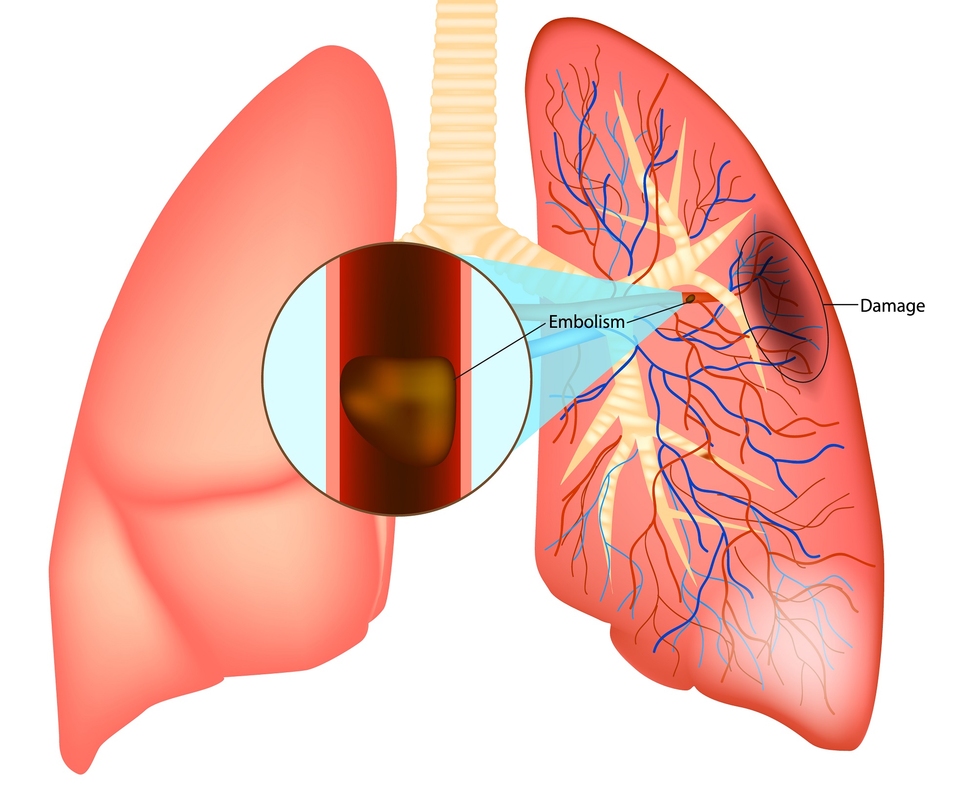 How Do You Say Pulmonary Embolism In Spanish