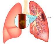 Pulmonary Embolism AEs Increase With DOAC Doses Against Manufacturer Recs