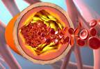Carotid Intima Media Thickness Not Reduced With Levothyroxine in Subclinical Hypothyroidism Carotid Intima Media Thickness Not Reduced With Levothyroxine in Subclinical Hypothyroidism