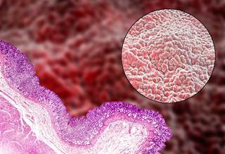 In terms of gastroprotection, PPIs were found to be superior. In terms of gastroprotection, PPIs were found to be superior.