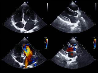 Right ventricular fractal dimension was a reproducible measure of remodeling in pulmonary hypertension, but it did not offer significant survival prediction compared with traditional markers. Right ventricular fractal dimension was a reproducible measure of remodeling in pulmonary hypertension, but it did not offer significant survival prediction compared with traditional markers.