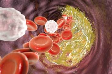 PCSK9 Inhibition: Benefits Outweigh Risks in Patients With Diabetes PCSK9 Inhibition: Benefits Outweigh Risks in Patients With Diabetes