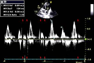 In patients with no reported tricuspid regurgitation velocity, pulmonary hypertension was associated with higher BMI, higher brain natriuretic peptide levels, diabetes, and heart failure. In patients with no reported tricuspid regurgitation velocity, pulmonary hypertension was associated with higher BMI, higher brain natriuretic peptide levels, diabetes, and heart failure.