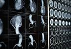 Chronic Total Occlusions on CCTA Increase Major Adverse Cardiac Event Risk Chronic Total Occlusions on CCTA Increase Major Adverse Cardiac Event Risk