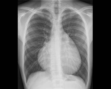 AHA/ACC: Updated Management Guidelines for Adult Congenital Heart Disease AHA/ACC: Updated Management Guidelines for Adult Congenital Heart Disease