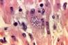 AHA Issues Scientific Statement on Managing Chagas Cardiomyopathy AHA Issues Scientific Statement on Managing Chagas Cardiomyopathy