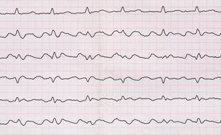 CHA<sub>2</sub>DS<sub>2</sub>-VASc scores may dictate clinical outcomes in atrial fibrillation and atrial flutter. CHA<sub>2</sub>DS<sub>2</sub>-VASc scores may dictate clinical outcomes in atrial fibrillation and atrial flutter.