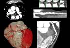 Coronary Artery Calcium Associated With ASCVD Events in Familial Hypercholesterolemia Coronary Artery Calcium Associated With ASCVD Events in Familial Hypercholesterolemia