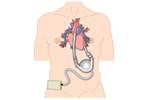 LVAD in Heart Failure Linked to Improved Glycemic Control LVAD in Heart Failure Linked to Improved Glycemic Control